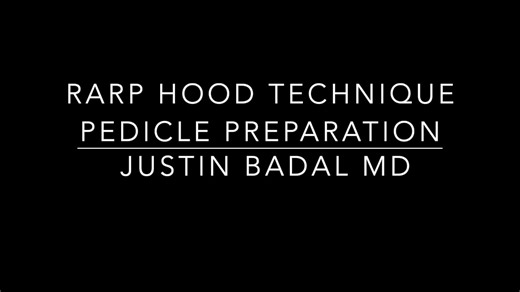 Robotic prostatectomy hood technique pedicle preparation