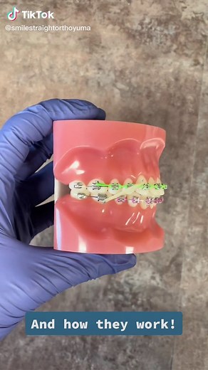 Exploring Different Ways to Use Rubber Bands on Braces