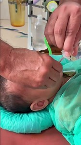 Intubation of general anaesthesia with ETT #baby #hospital #anesthesia #medicalshorts #shorts #fypシ