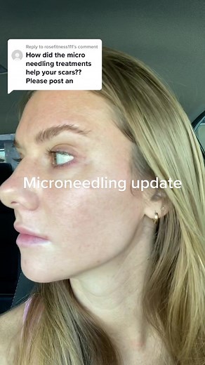 Microneedling Update: Day 2 Microblading Experience