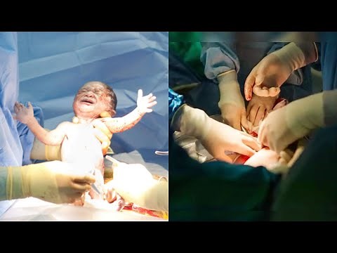 Normal delivery vs Caesarean: Are doctors wielding the knife too often?