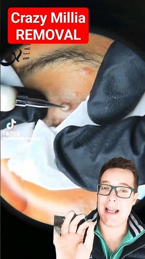 CRAZY HUGE MILIA REMOVAL - How To Get Rid of Milia #shorts