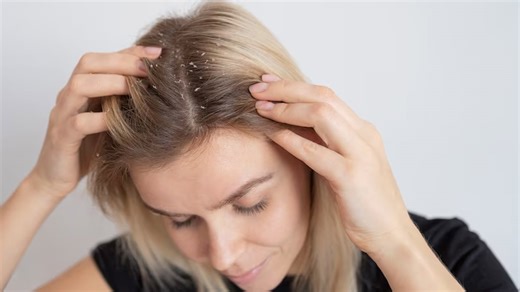 Redness On Scalp? Expert Lists Signs Of Scalp Eczema And Its Types