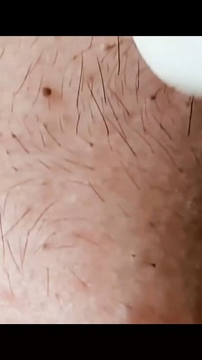 Pimple Popping 2021 on Instagram: "Rate this video 1-10?. . . . #pores #acne #skincare #blackheads #pimples #whiteheads #pimple #blackhead #skin #beauty #blackheadextraction #blackheadremoval #pimplepopping #whitehead #pimplepop #pimplepoppers"