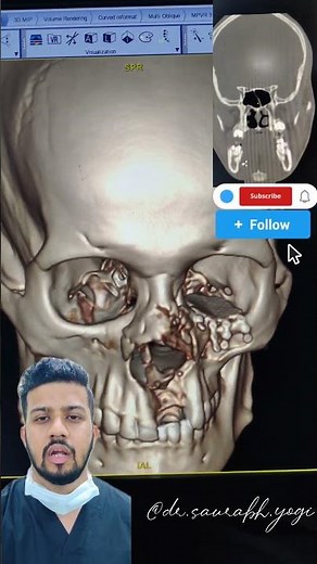 Floor Of Orbit Fracture With Orbital Mesh | Orbital Surgery |Maxillofacial surgery #neetexam #marrow