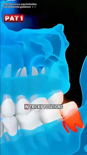 How to Tooth Extraction Process (3D Animation)#toothextraction#toothextractionsurgery