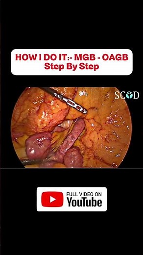 How I Do It: MGB - OAGB | A Complete Step-by-Step Surgical Guide | #weightlosssurgery #doctor