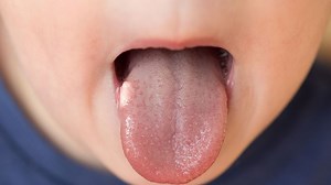 Stomatite : définition, causes, diagnostic, prévention et traitements