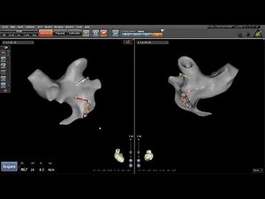 Left Atrial Anatomy using Carto® 3 and FAM