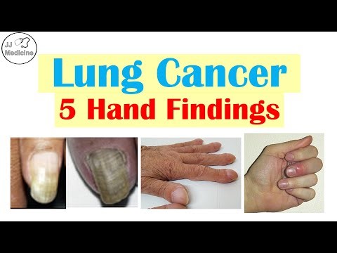 Don’t Ignore These 5 Hand Findings Linked to Lung Cancer