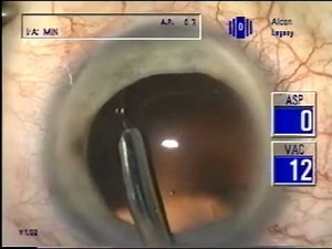 Capsule Tension Ring • Video • MEDtube.net