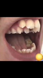 Double Trouble 😵‍💫 Supernumerary or Retained Deciduous #Dentistry #LearningTips #BitesnBraces | Bites & Braces Dental