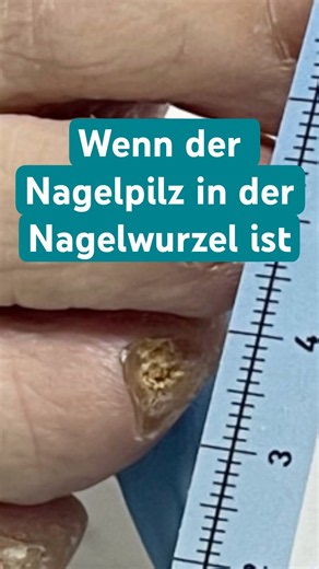 When nail fungus reaches the root, there is still one solution