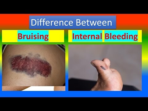 Difference between Bruising and Internal Bleeding