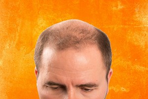Baldness Cured? Breakthrough Serum Grows Mice Hair Back in Just 20 Days