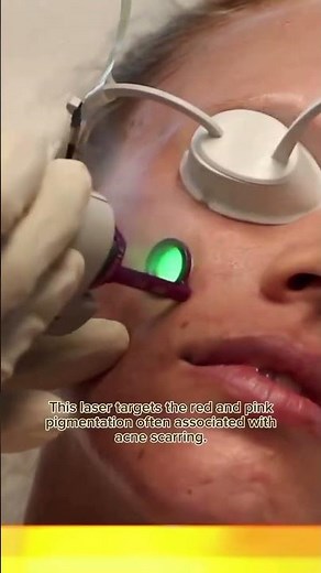 From Red & Scarred to Radiant | Vbeam Laser Skin Transformation