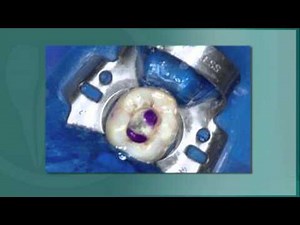 Uses of Ultradent's PermaFlo Purple After Root Canal Therapy