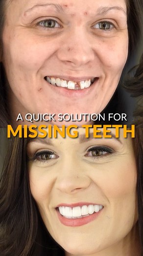 If you have MISSING TEETH you need to watch this video! 🦷 Don't let the cosmetic dentist discourage you with a $10,000 price tag for implants! For just $149 down, you can get a custom-designed smile quickly delivered to your door!—No dentist, no outrageous bills, just results. Watch now! Learn more at: https://brighterimagelab.com/ #BrighterImageLab #BIL #Veneers #RemovableVeneers #DentalVeneers #SnapOnVeneers #ClipOnVeneers #IncrediBIL #BILVeneers #IncrediBILVeneers #BrighterImageLabVeneers #S