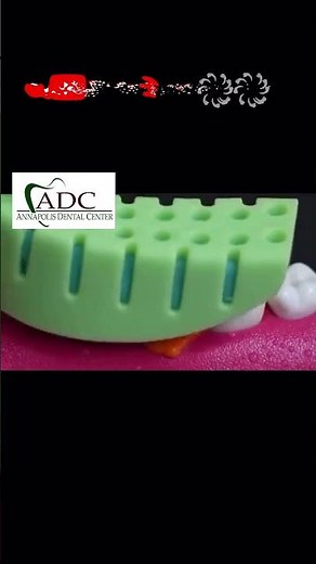 Cavity completely removed!