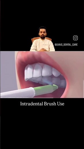 #proxabrush #Intradentalbrush #teethcleaning #oralhygiene #dentalcare #uvaisdentalcare
