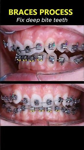 Amazing braces. Fix deep bite teeth and crooked. Resue smile #braces #orthodontist #dentist #smile