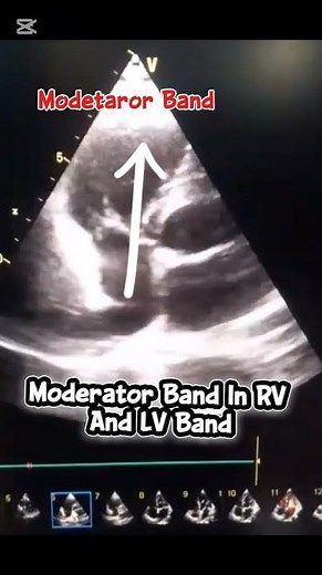 LV Band And Moderator Band In RV #heartcondition #heartdisease #cardiovascularhealth #sonography