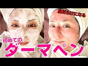 [Viewer discretion advised!] Dermapen: It's bloody, but does it improve your skin? [Cosmetic trea...