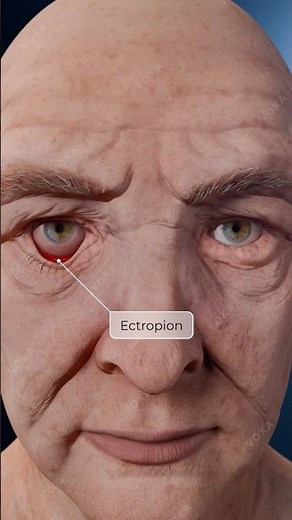 Ectropion: Lower Eyelid Malposition and Surgical Correction in 3D