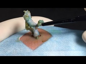 BEST Pimple Popping // Big Cystic Acne Blackheads // Whiteheads Removal / Squeezing Pimples / H#069