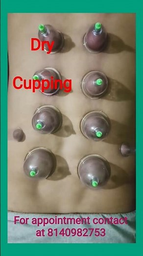 Cupping therapy | Hijama therapy treatment for body detox : how it works