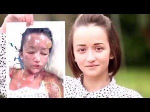 Stevens Johnson Syndrome! Cysts, Blisters, Boils, Medical, Popping, Education, Documentary!