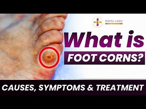 What is Foot Corns? | Causes, Symptoms & Prevention | Foot Corn Treatment | Foot Callus Removal