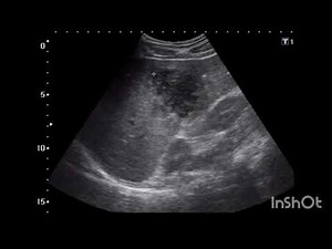 Understanding Pyogenic Liver Abscess Through Ultrasound Imaging