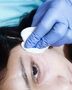 3K views · 88 reactions | Under eye threads to get new collagen under eyes and to reduce creepy puffiness on the same area.. aurishartmedic #clinic #institute #Aesthetics #medicine #DrSehrish #DrAun #AestheticsPhysician #Cosmetologist #MedicalAesthetician ##PMUspecialist #pioneers in #trainings #internationally #UAE #London #clinics #Lahore #karachi #appointments #Lahore 03314303938 +923434551576 #karachi 03343785123 | Expression Aesthetics | Facebook