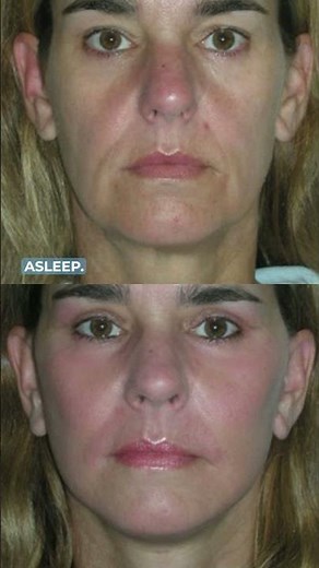 Cheek Implants: Recovery, Benefits, and Comparisons #medicaleducation #cosmeticsurgery #aacs