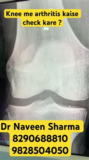 Dr Naveen sharma explains how to see arthritis in knee X-ray ?