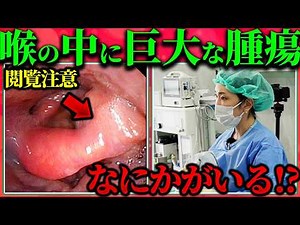 [Huge Tumor in the Throat] An ENT Doctor Explains "Throat Cancer" That Often Goes Ignored [Laryng...