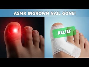 ASMR Ultimate Ingrown Toenail Removal 2025 | Satisfying Animation Fix