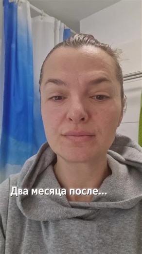 Recovery Insights for Lower Blepharoplasty Post-Op