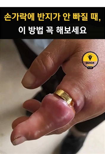 손가락에 반지가 안 빠질 때 해결하는 방법