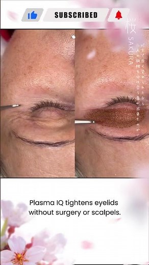 Plasma IQ: Non-Surgical Eyelid Tightening with Visible Rejuvenation