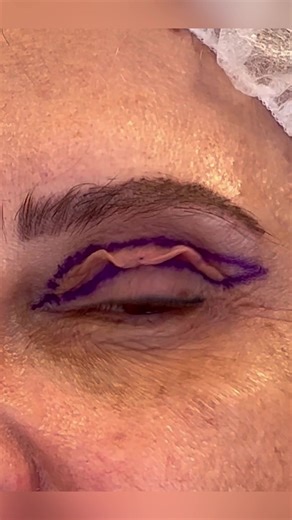 #blepharoplasty #antiagingskincare #docbergereffect #lidstraffung #beautifuleyes #eyemakeup #permanentmakeup #newlife #bodytransformation #beforeafter #münchen #tutorial