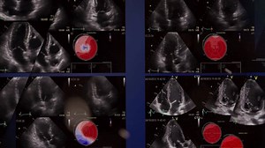 79K views · 79 reactions | There is a new way to look at cardiac function that is now absolutely ready for prime time. Get ahead of others in echo. 123sonography.com/speckletracking | 123sonography | Facebook