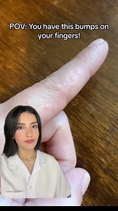 725K views · 709 reactions | Dyshidrotic eczema is a skin condition that causes small blisters on the palms of hands, soles of the feet and edges of the fingers and toes. If you have it, wash your hands only with a gentle cleanser and Keep your hands moisturized! #eczema #dyshidrotic | Dr. Farzan | Facebook