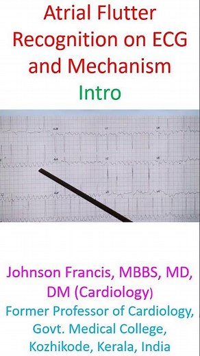 Atrial Flutter Recognition on ECG and Mechanism