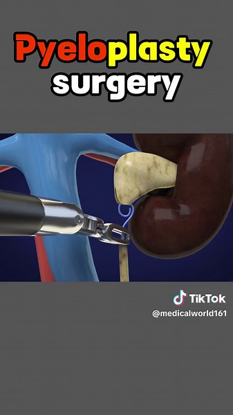 Pyeloplasty surgery #Pyeloplasty #surgery #treatment #procedures #kidneydisease #kidneydonor #kidneydiseaseproblems #3danimation #watch #foryou #foryourpage