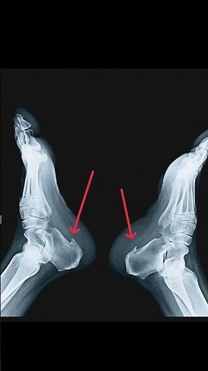 X-ray calcaneal spur of heel B/L