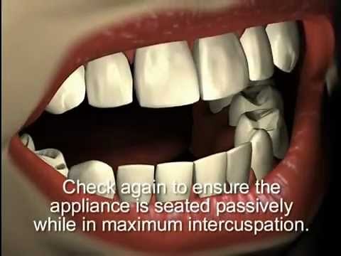 Mini Dental Implants - MILO by Intra-Lock Shatkin FIRST Distributor