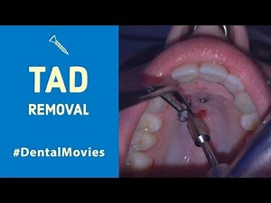 TAD removal