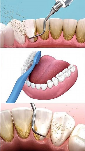 Tooth brushing — proper technique, plaque removal, healthy gums. #dentist